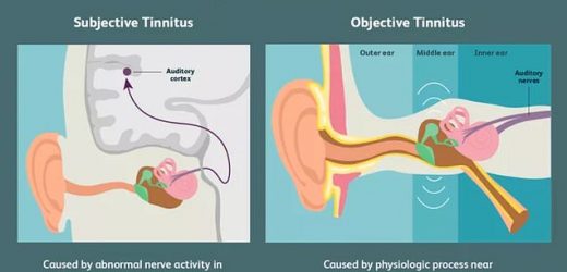 Covid vaccines and tinnitus: What we know so far