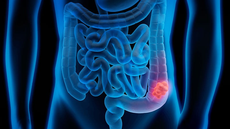 Does Young-Onset Adenoma Require More Intense Surveillance?