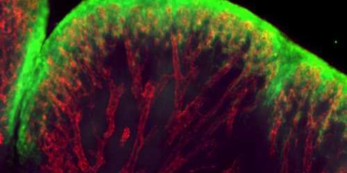 Gum disease may lie at the root of some arthritis flareups