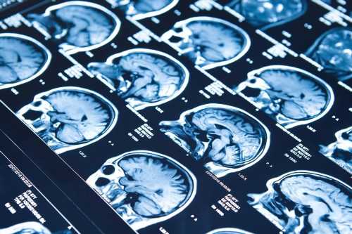 Study reveals subtle brain asymmetry differences in schizophrenia