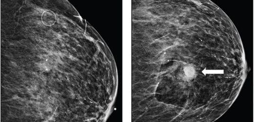 Bleeding after image-guided breast biopsies: Discontinuing vs. maintaining antithrombotic therapy