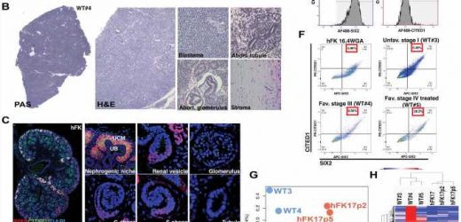 Researchers uncover new clues to origins of the most common pediatric kidney cancer