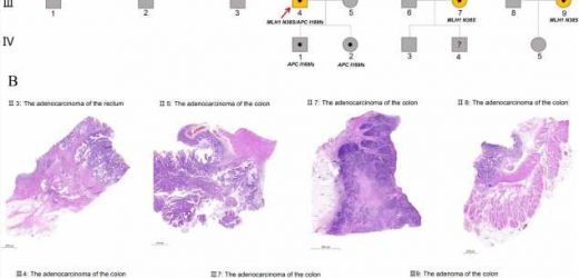 Study reveals somatic mutation profile of colorectal tumor with simultaneous APC and MLH1 germline mutations
