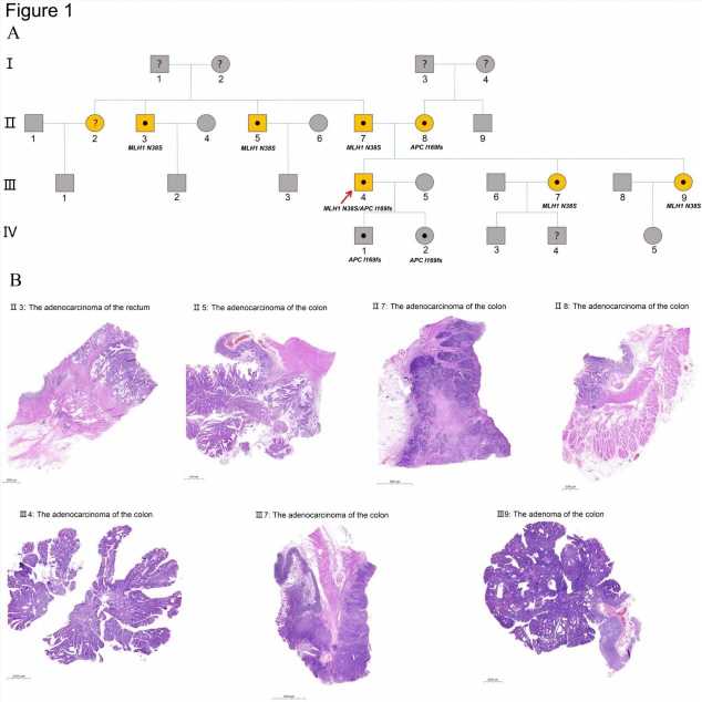 Study reveals somatic mutation profile of colorectal tumor with simultaneous APC and MLH1 germline mutations