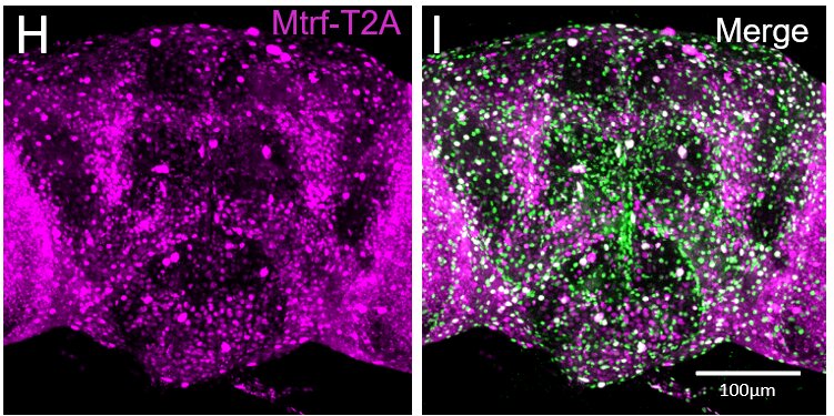 Variants of MRTFB gene linked to novel neurodevelopmental disorder