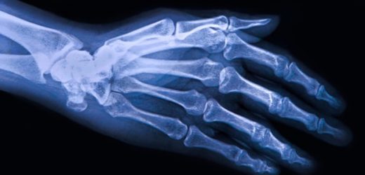 Association between healthy lifestyle and mortality in people with osteoarthritis