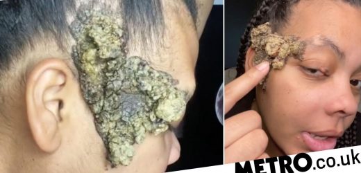 Birthmark on mum's face started growing and wouldn't stop after she gave birth