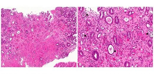 Mixed Results for Drug in Eosinophilic Gastritis