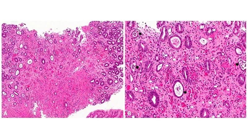 Mixed Results for Drug in Eosinophilic Gastritis