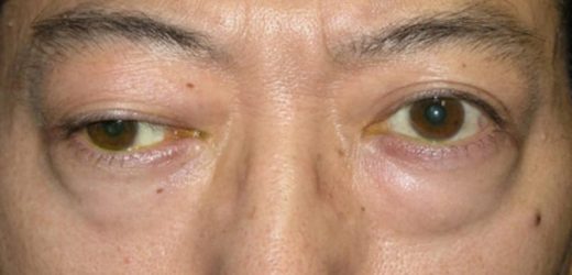 Myasthenia Gravis Drug Gets FDA Nod