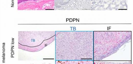 Immobilizing mucosal melanoma: Eliminating a protein could lead to a potential treatment