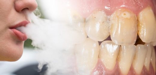 This is what vaping is doing to your teeth