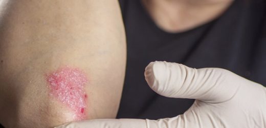 Vitamin D levels could play an important role in psoriasis severity