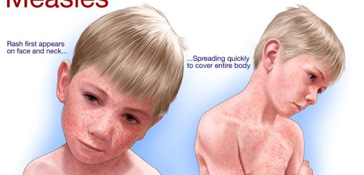 Preventing measles outbreaks in the US through vaccination