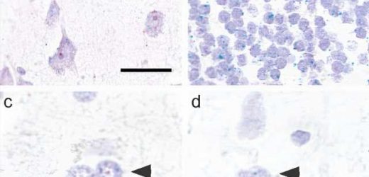 Study suggests two-pronged approach to treatment for neurodegenerative disease