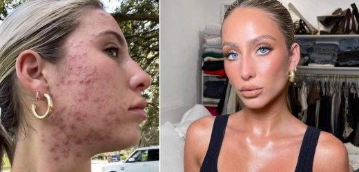 Woman who cried 'three times a day' about acne shares incredible transformation