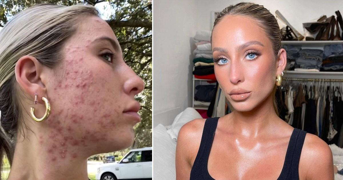 Woman who cried 'three times a day' about acne shares incredible transformation