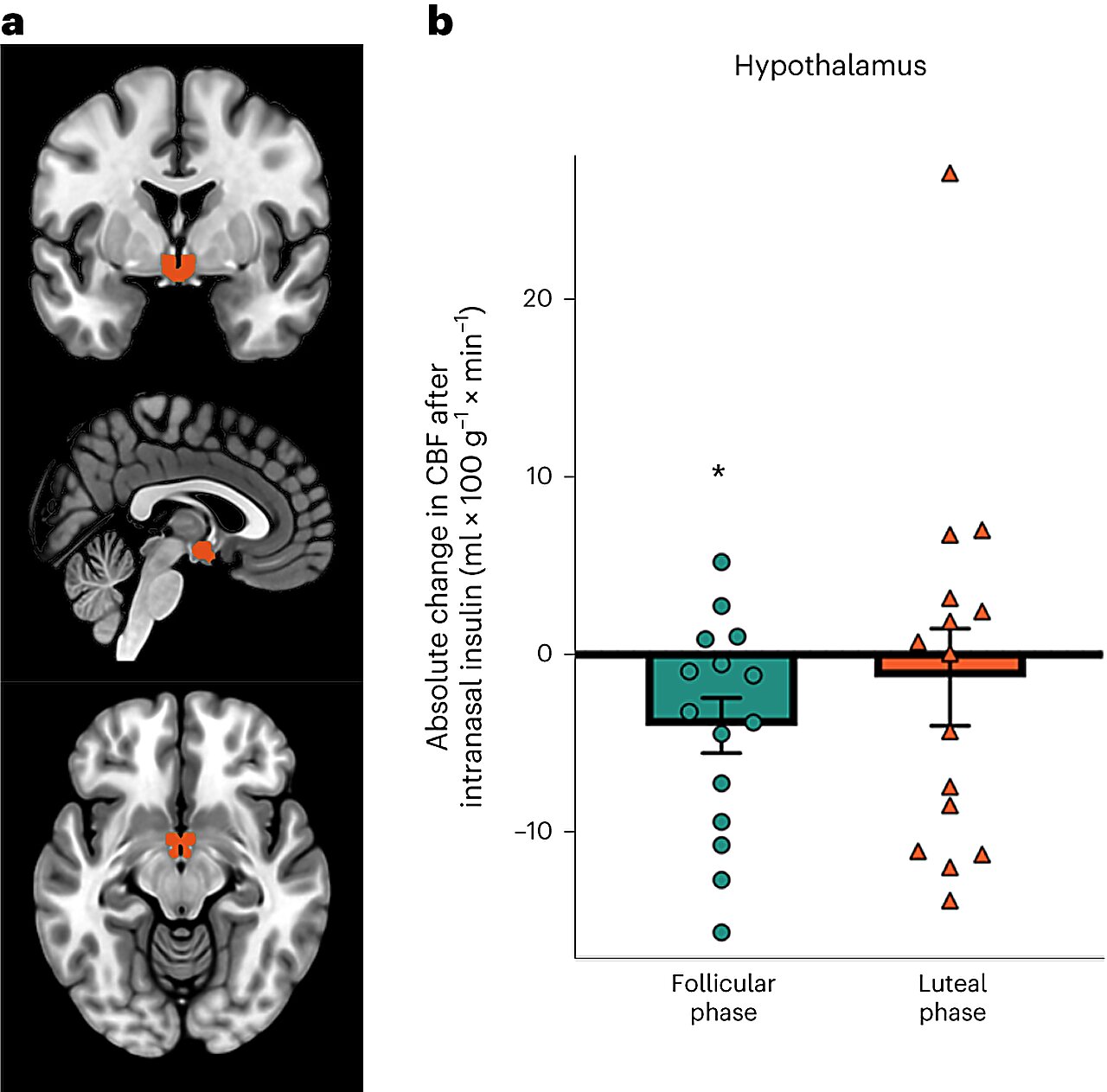 Brain sensitivity to insulin may be modulated by menstrual cycle