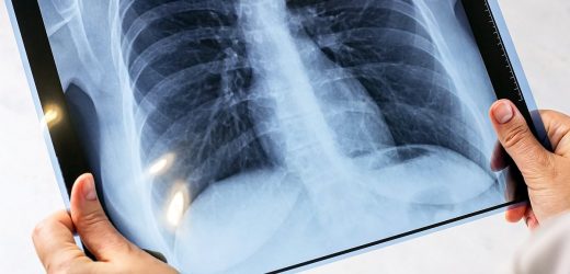 Cases of Victorian disease surge in England – as map reveals hotspots