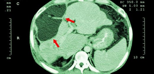 High-Risk Polyps at Colonoscopy Linked to Liver Cancer Death