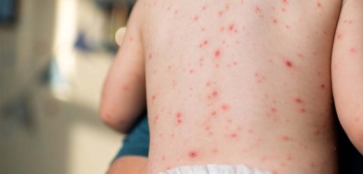 New strain of highly contagious chickenpox virus found first time in India