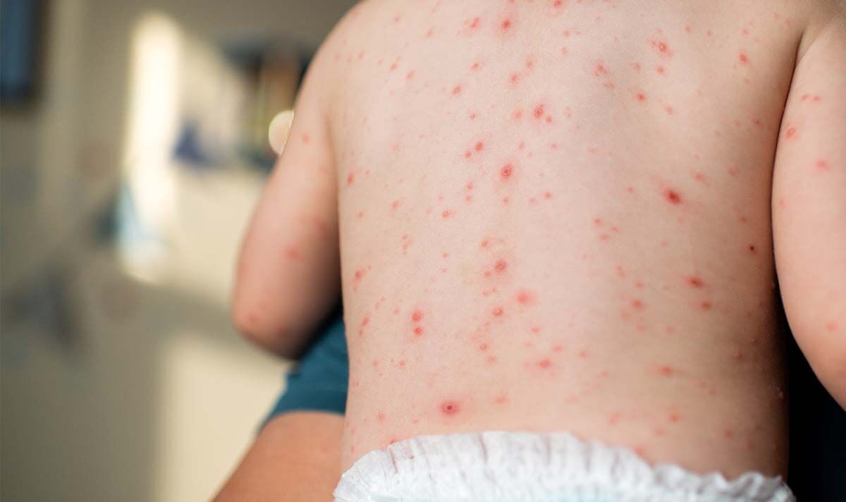 New strain of highly contagious chickenpox virus found first time in India