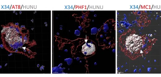 New study discovers how neurons die in Alzheimers disease