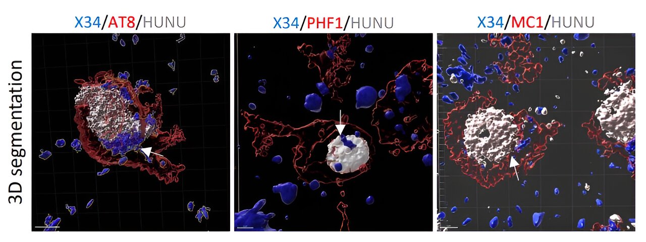 New study discovers how neurons die in Alzheimers disease