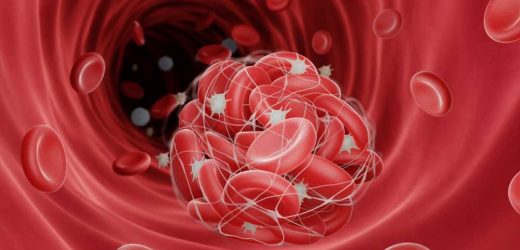 Non-alcoholic fatty liver disease linked to higher risk of blood clots in healthy adults