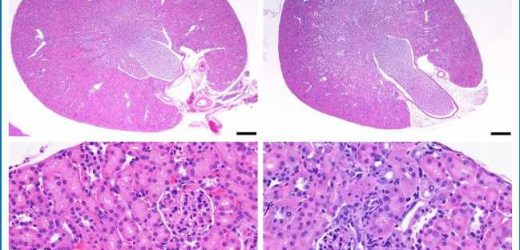 Nuclear medicine treatment cures lethal form of ovarian cancer in preclinical setting