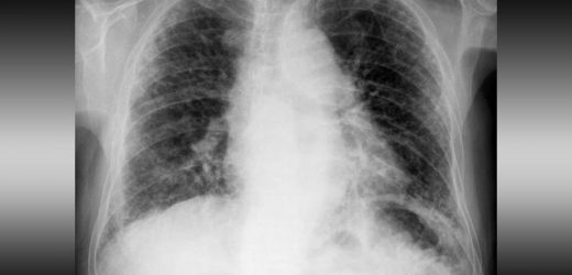 Progressive Pulmonary Fibrosis: Treatment and Support