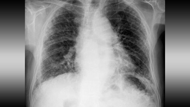 Progressive Pulmonary Fibrosis: Treatment and Support
