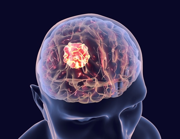 Researchers receive $2.5 million award to develop a tailored treatment for glioblastoma