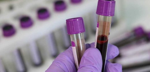 Both high and low HDL cholesterol tied to increased risk of dementia
