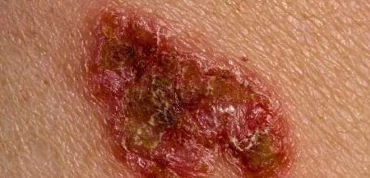 Melanoma now no longer the leading cause of skin cancer deaths