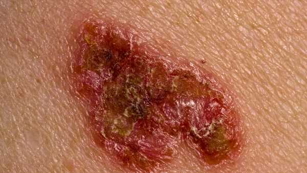 Melanoma now no longer the leading cause of skin cancer deaths