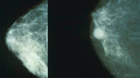 Short-course radiation as effective for patients who opt for breast reconstruction after mastectomy