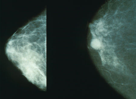 Short-course radiation as effective for patients who opt for breast reconstruction after mastectomy