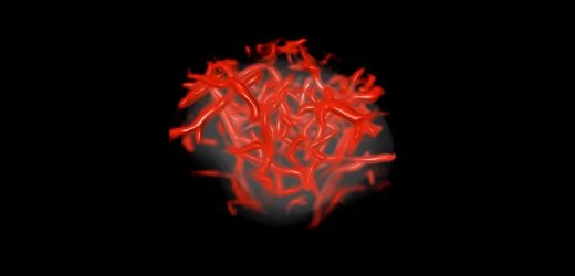 Advancing ultrasound microvessel imaging and AI to improve cancer detection
