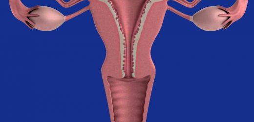 Endometriosis can complicate hysterectomies, study shows