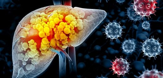 Fewer Than 1 in 4 Patients With HCV-Related HCC Get DAAs