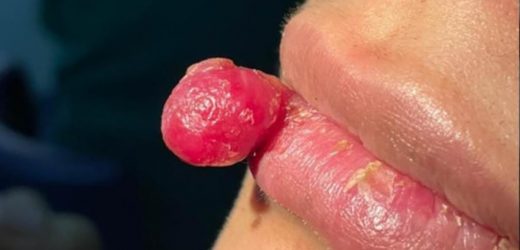 Pregnant women grow tumors on their lips and tongues after injuries
