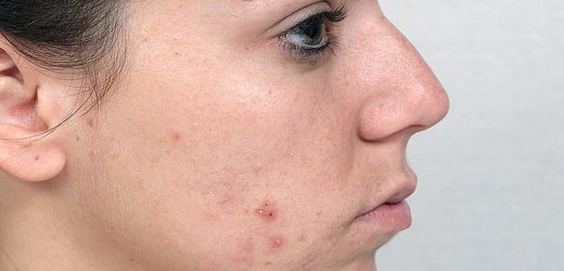 Review Estimates Acne Risk With JAK Inhibitor Therapy
