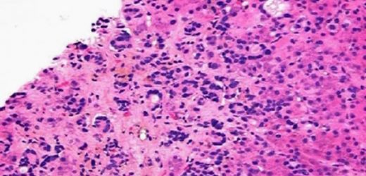 Vaginal Estrogen Therapy Safe for Women With Breast Cancer